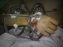 Апарат Ілізарова ілізарова
