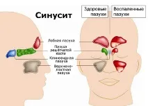 синузит лечение