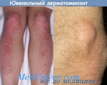 лечение ювенилен