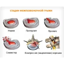 лечение лечение