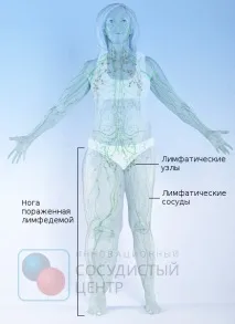 лимфостаза лимфостаза
