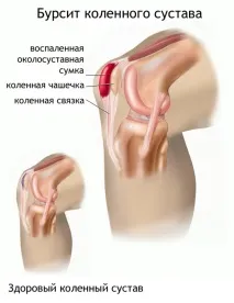 суглоба