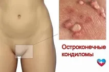 Що таке гострі кондиломи кондиломи