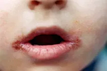 деца лекуват