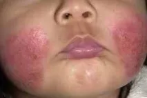 екзема деца