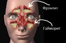 фронтален синузит