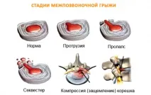 гръбначния херния
