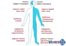 инсулт инсулт