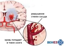 хеморагичен инсулт