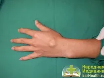 Гігрома зап’ястя - симптоми, лікування, причини, фото гігрома