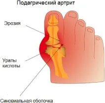 подагра подагра