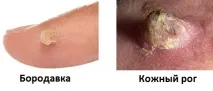 Як відрізнити бородавку від шкірного рогу, Клініка Лазмед шкірного