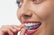 Капи для вирівнювання зубів Інвізілайн (Invisalign) інвізілайн