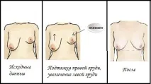 Корекція асиметрії грудей асиметрії
