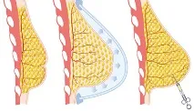 Корекція асиметрії грудей молочних залоз