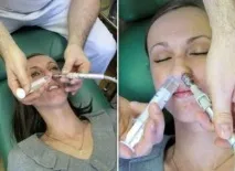 Зозуля при гаймориті що це за процедура (відео) відео