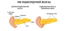 Лікування раку підшлункової залози в Ізраїлі. раку