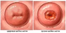 Лікування шийки матки в Єкатеринбурзі матки