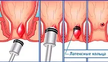 латексно хемороиди