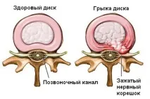 херния дискова