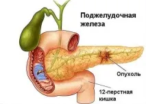 Лікування раку підшлункової залози в Ізраїлі. раку