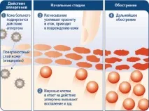 Мазі від дерматиту та шкірних захворювань у дорослих шкірних