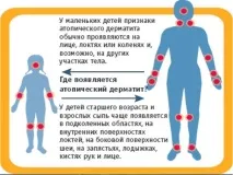 Мазі від дерматиту та шкірних захворювань у дорослих дорослих