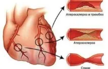 Мультифокальний атеросклероз - що це таке, причини та лікування мультифокальний