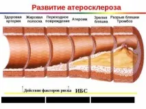 Мультифокальний атеросклероз – причини, симптоми та лікування мультифокальний