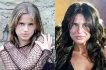 хейлопластика хейлопластика