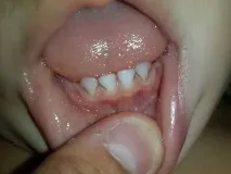 плака отървете