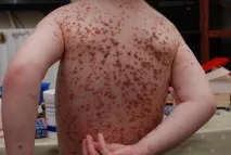 ускладнення