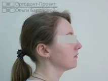 адентия лечение