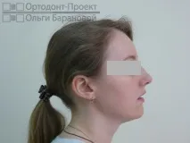 адентия ортодонтско