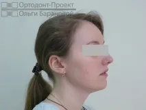 лечение адентия