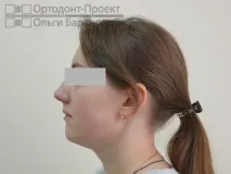 адентия адентия