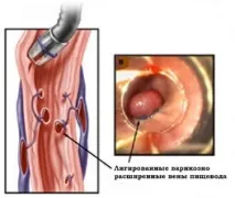 Операції на стравоході види та особливості проведення стравоході