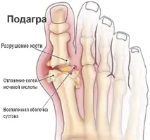 Подагра що це таке, причини, симптоми, лікування, профілактика таке