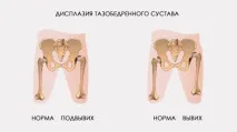 дисплазия тазобедрената става