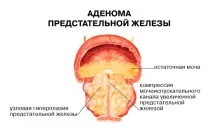 аденом ниво
