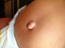 пъпна херния