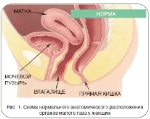 Пролапс геніталій, Пушкар Д пушкар