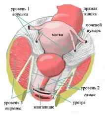 Пролапс матки - Хвороби - Медичний центр Клініка Здоров’я хвороби