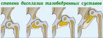 тазобедрената става дисплазия