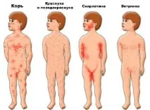розеола лечение