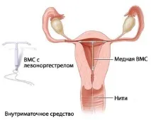 контрацепция контрацепция