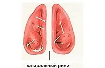 Синусит що являє собою, особливості терапії та симптоматика собою