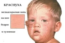 рубеола висок риск