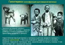 Симптоми гіпотиреозу та гіпертиреозу порівняння та відмінності гіпертиреозу