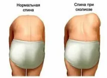 сколіоз